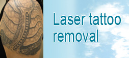 laser removal of tattoo